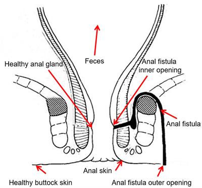 Microbiomic signatures of anal fistula and putative sources of microbes